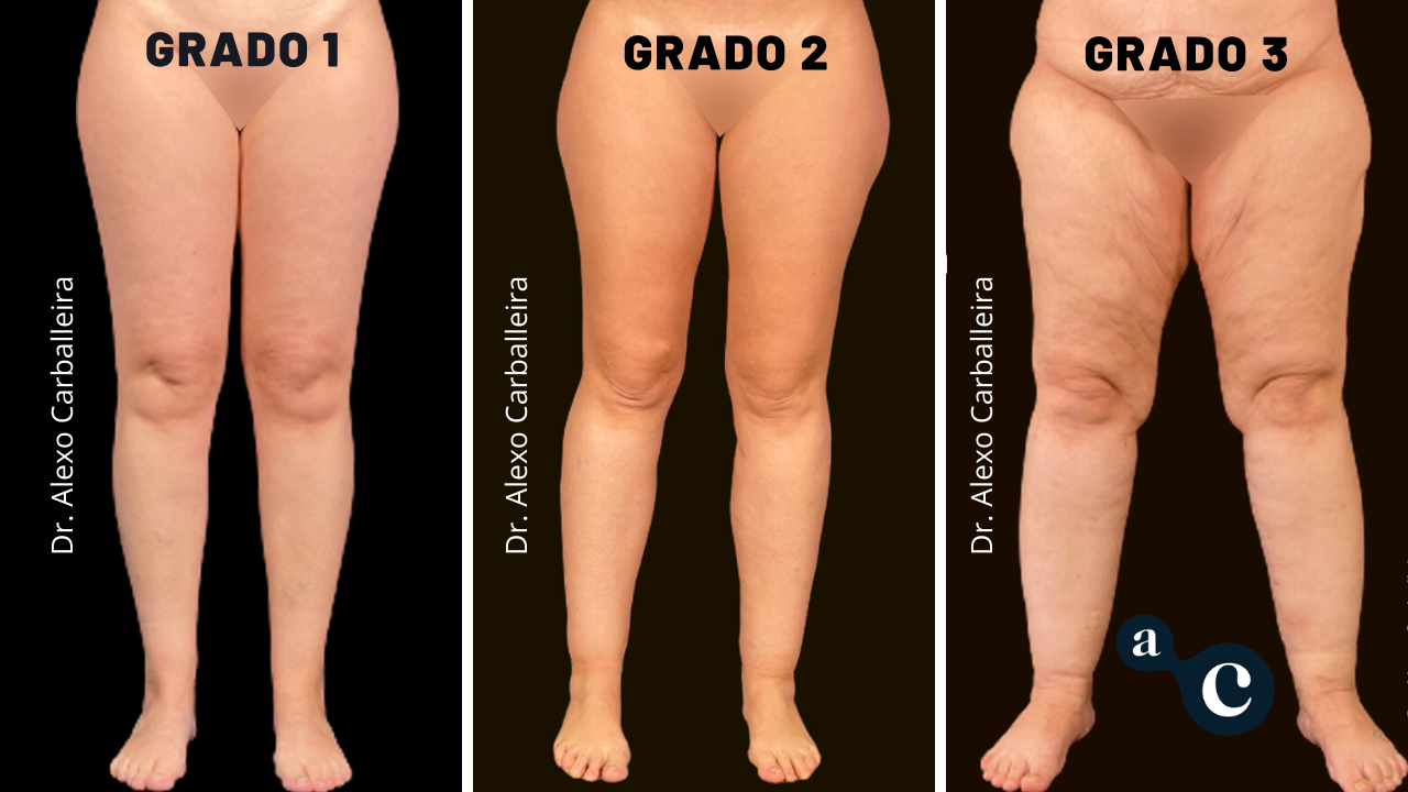 grados lipedema