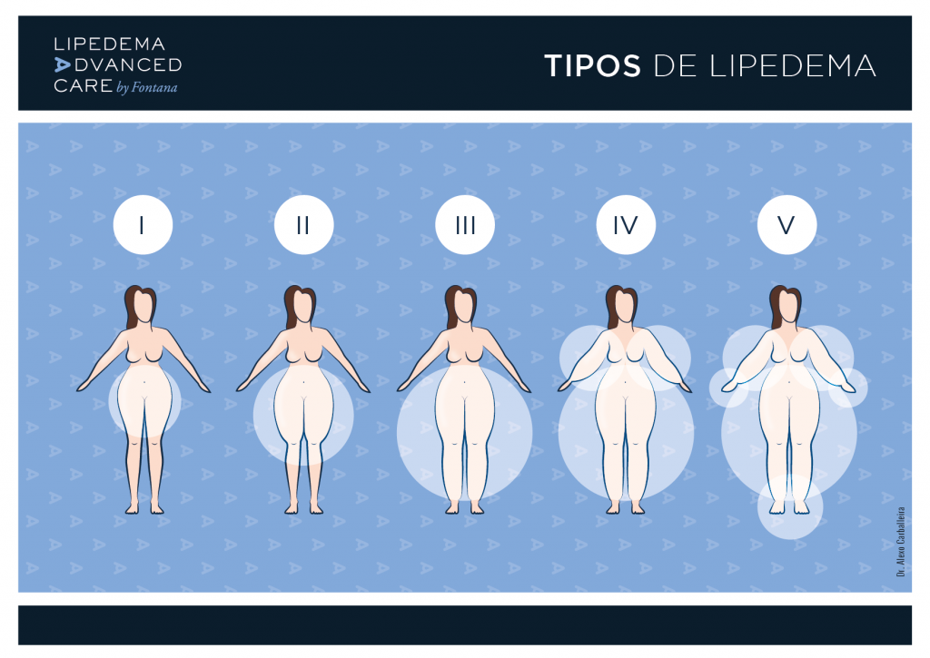 Grades And Types Of Lipedema: Complete Classification And ...
