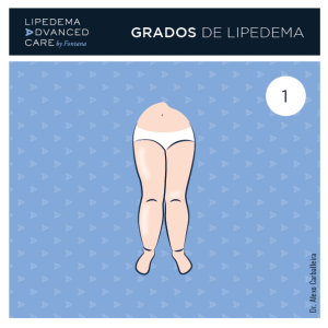 Lipedema_Grado 1