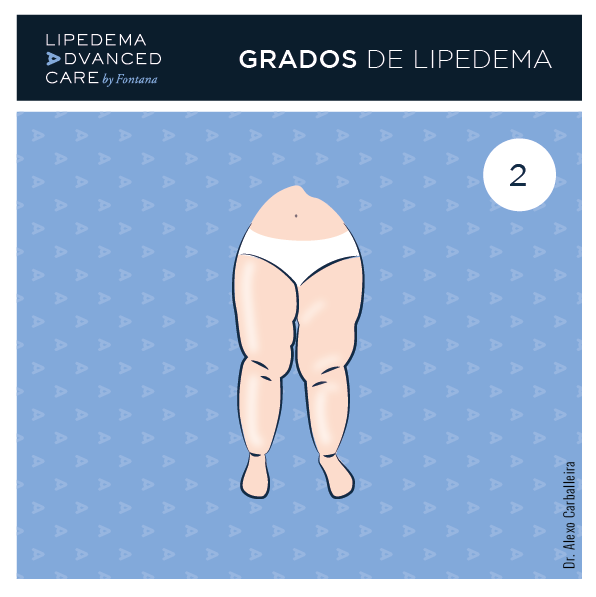 Imagen de lipedema grado 2 en piernas: piel con ondulaciones y nódulos