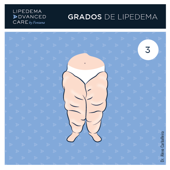 Imagen de lipedema grado 3 en piernas: lóbulos de grasa y deformidad del contorno