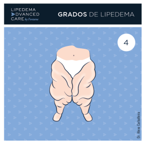 Lipedema_Grado 4