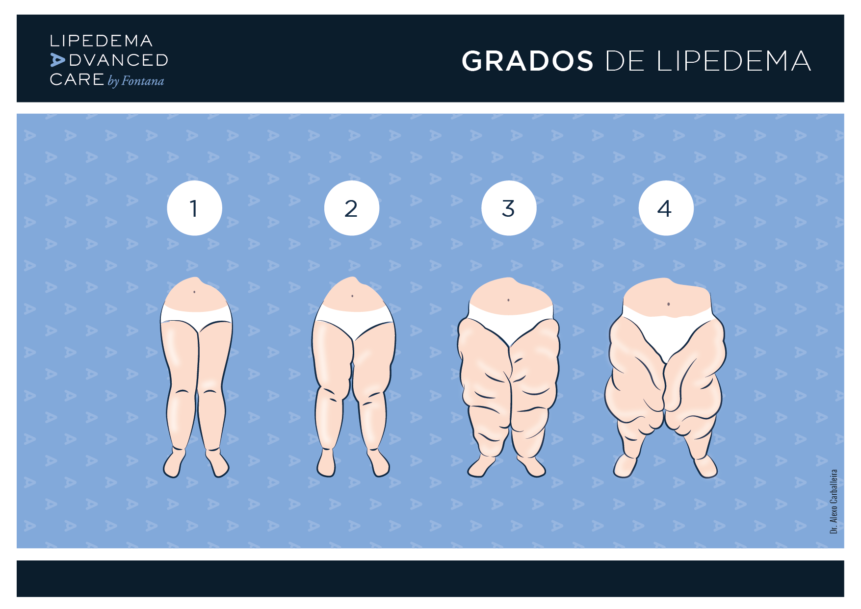 Imagen de los 4 grados del lipedema: comparativa del grado 1 al grado 4 en las piernas