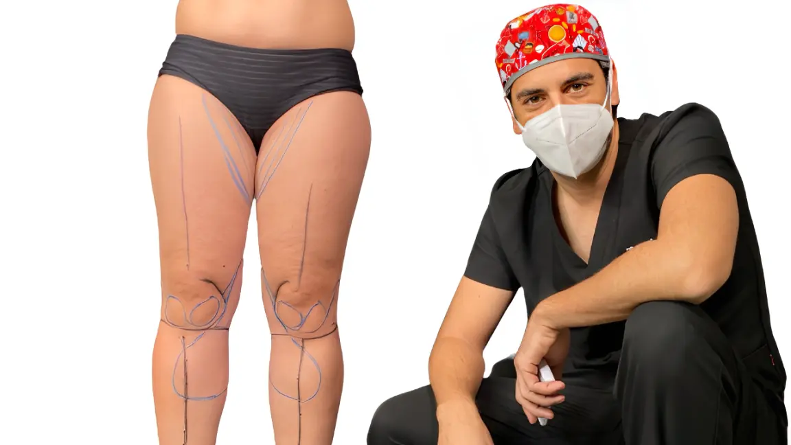 El Lipedema, la enfermedad que se confunde con la Obesidad o Celulitis