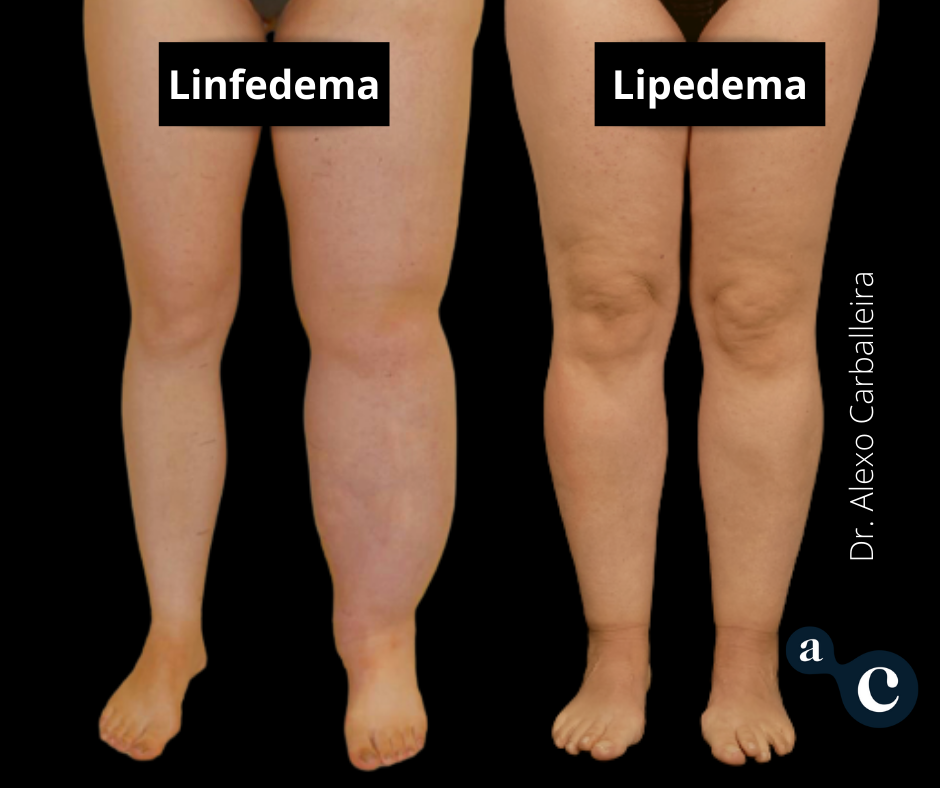 linfedema vs lipedema