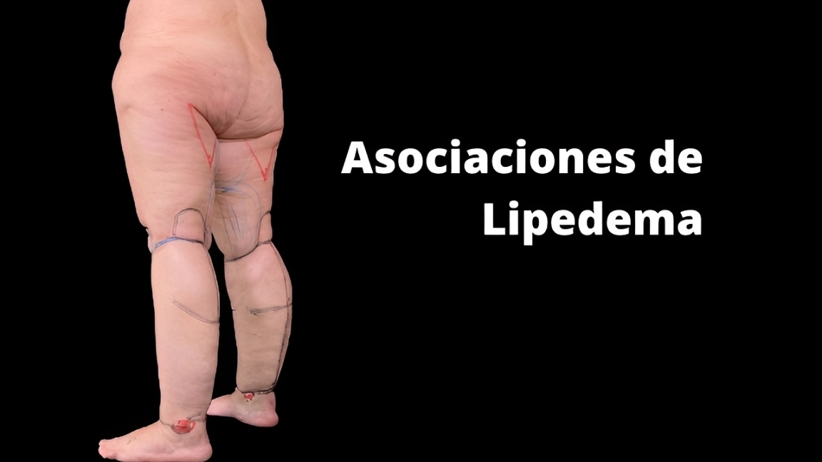 Asociaciones de Lipedema en España