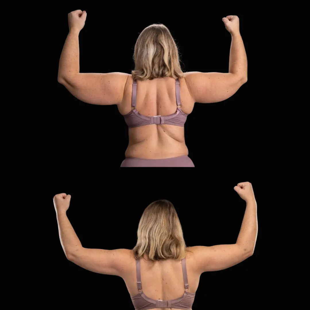 Lipedema en Brazos Resultado