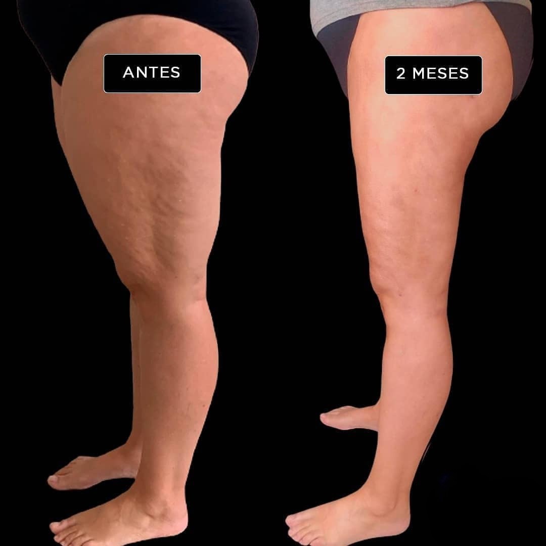 Resultado Lipedema Piernas Completas