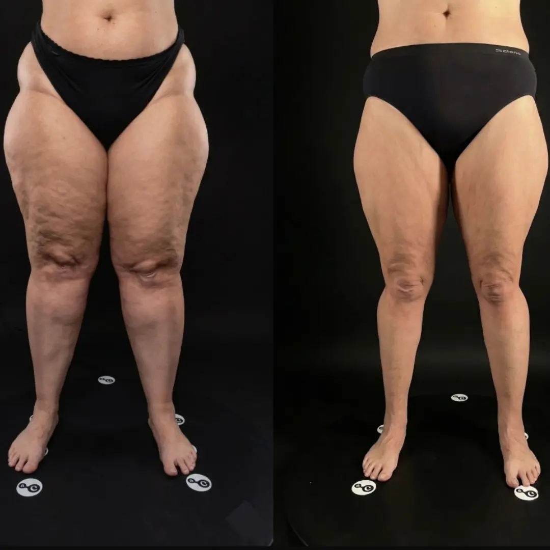 Resultado Lipedema Piernas Completas