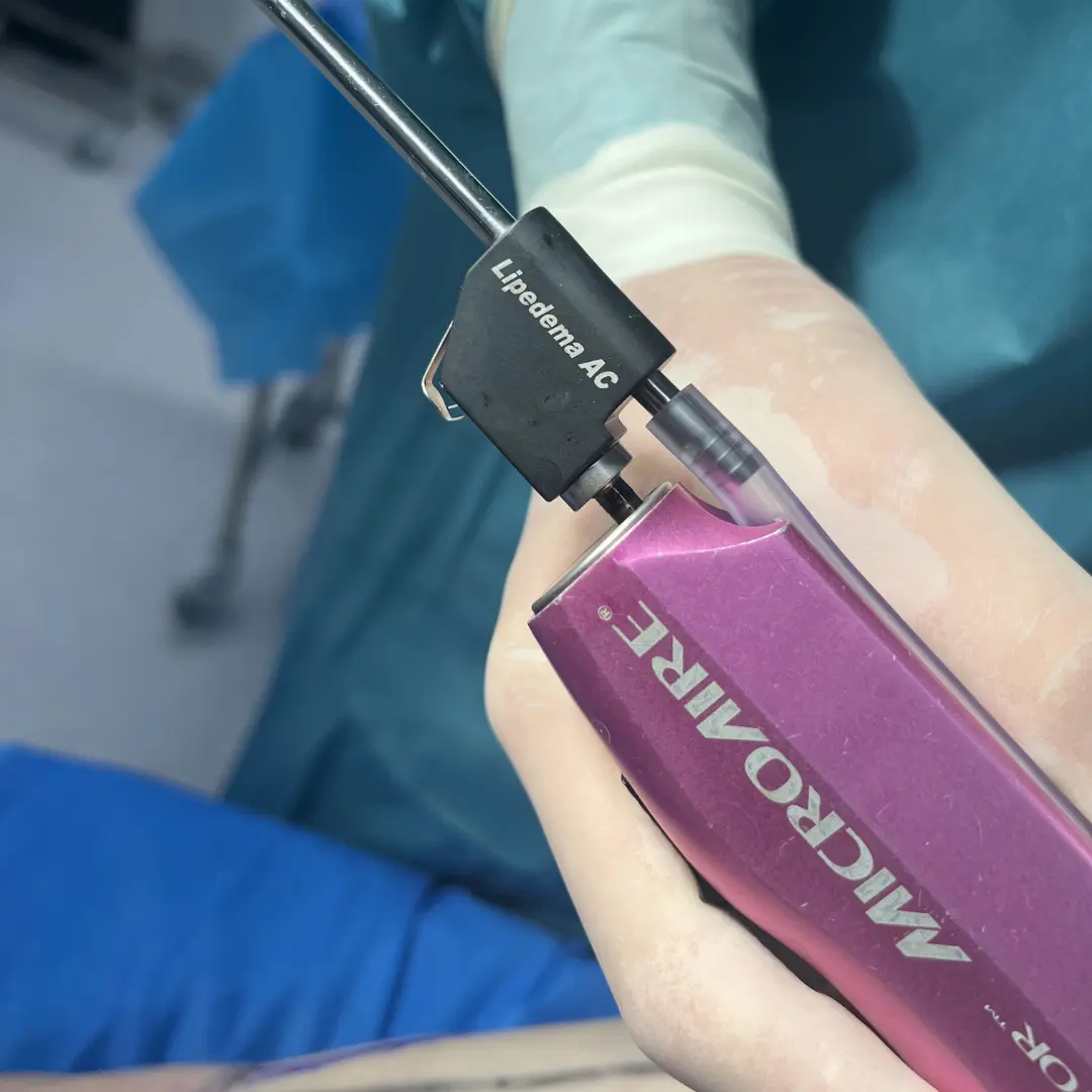 Liposucción PAL 1 PAL (Microaire) liposuction cannula in the operating room