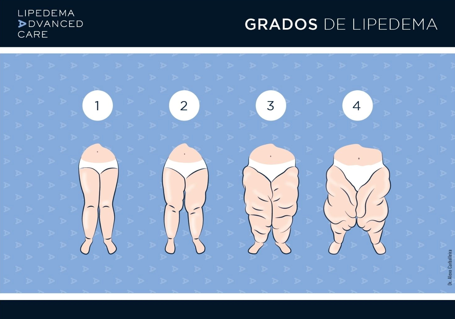 Imagen de los 4 grados del lipedema: comparativa del grado 1 al grado 4 en las piernas