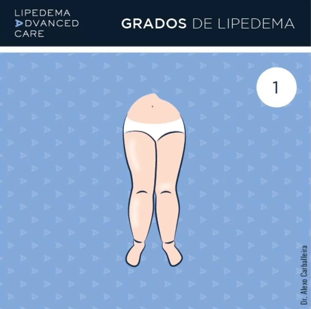 Imagen de lipedema grado 1 en piernas: piel lisa con nódulos palpables
