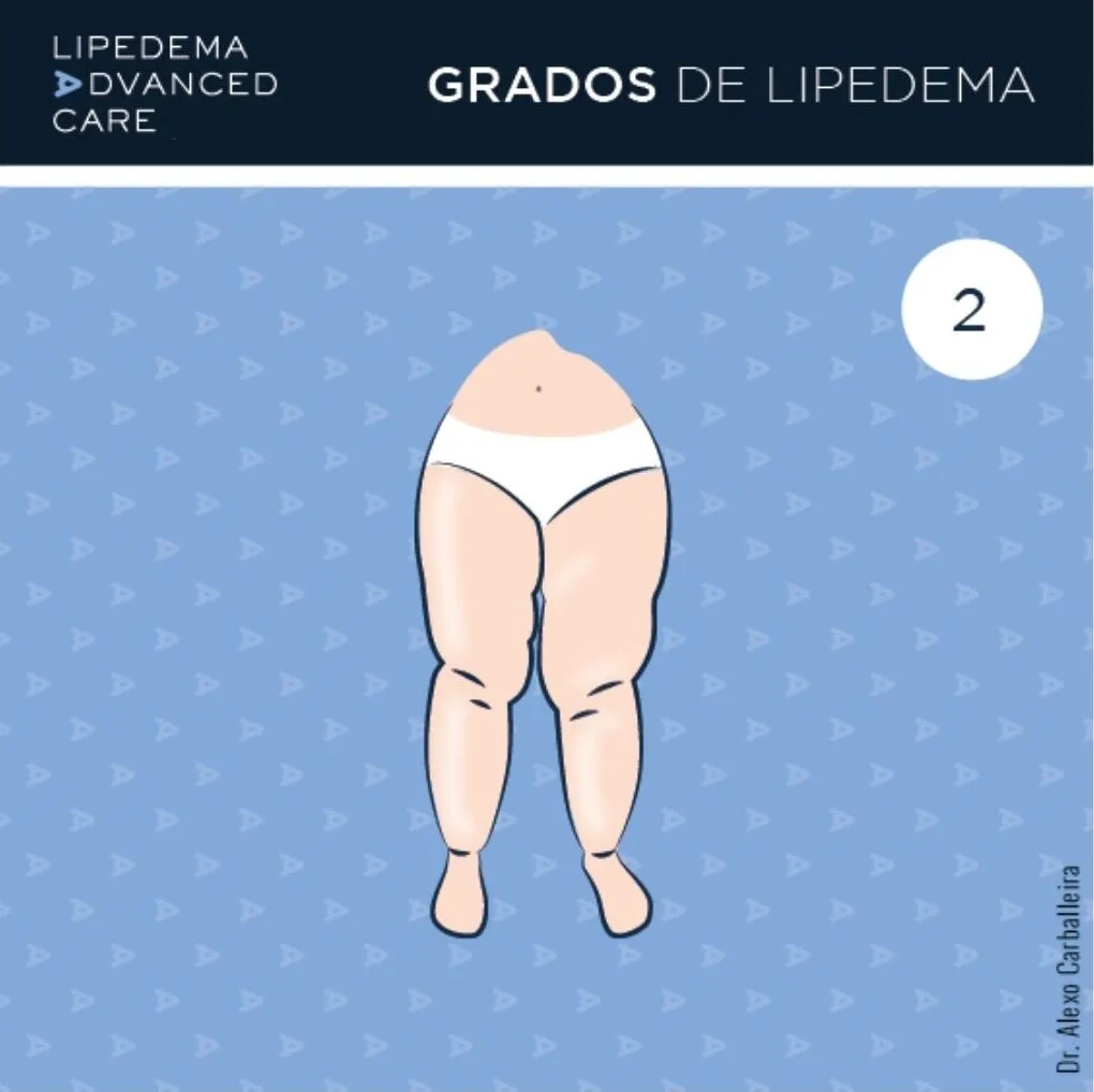 Imagen de lipedema grado 2 en piernas: piel con ondulaciones y nódulos