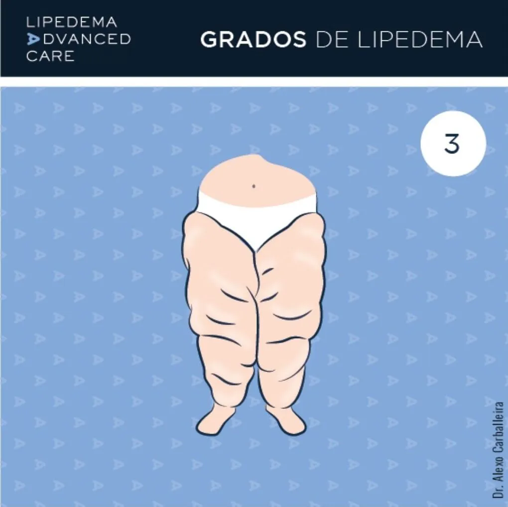 Imagen de lipedema grado 3 en piernas: lóbulos de grasa y deformidad del contorno
