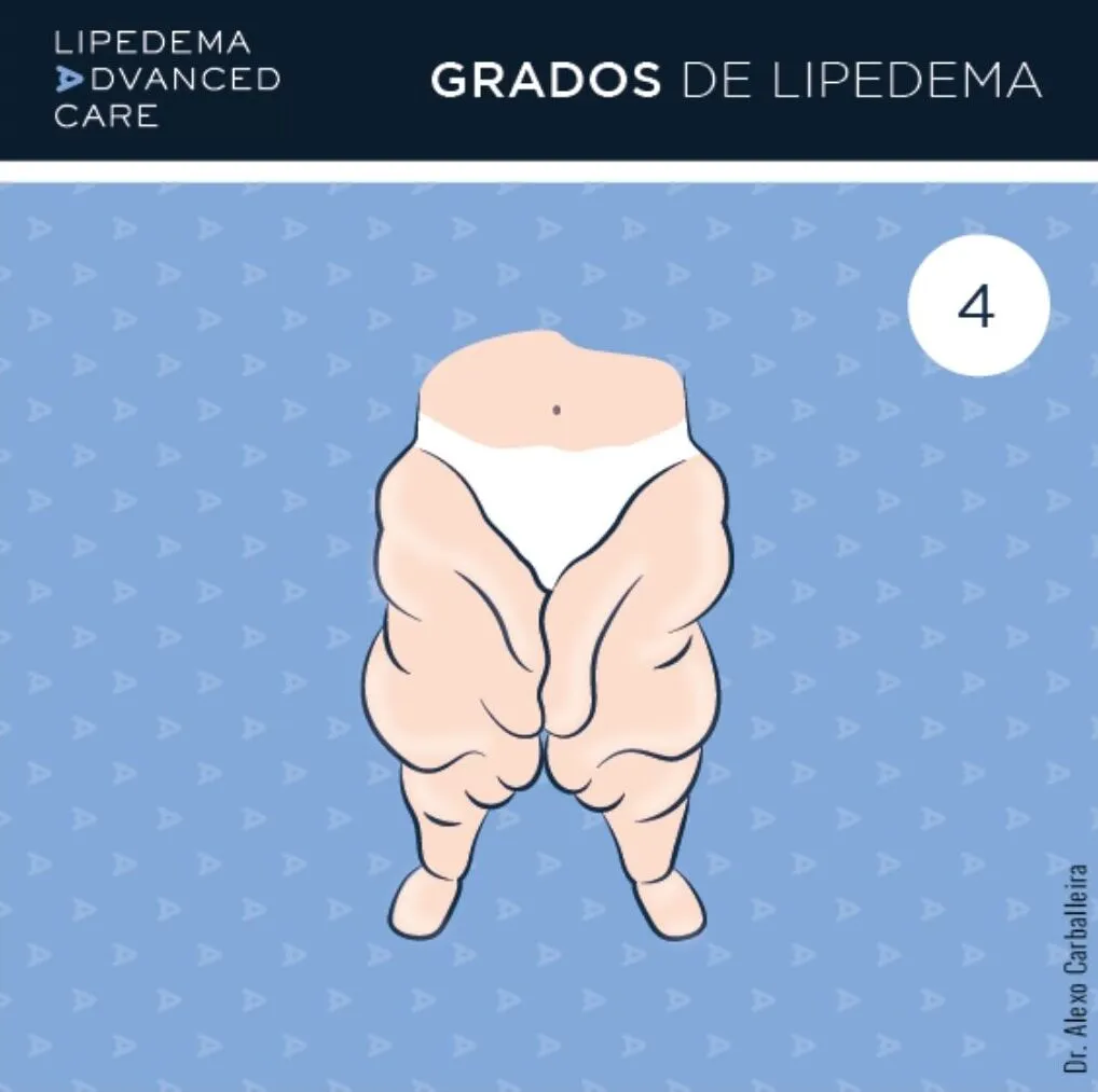 Imagen de lipedema grado 4 o lipolinfedema: edema con componente linfático asociado