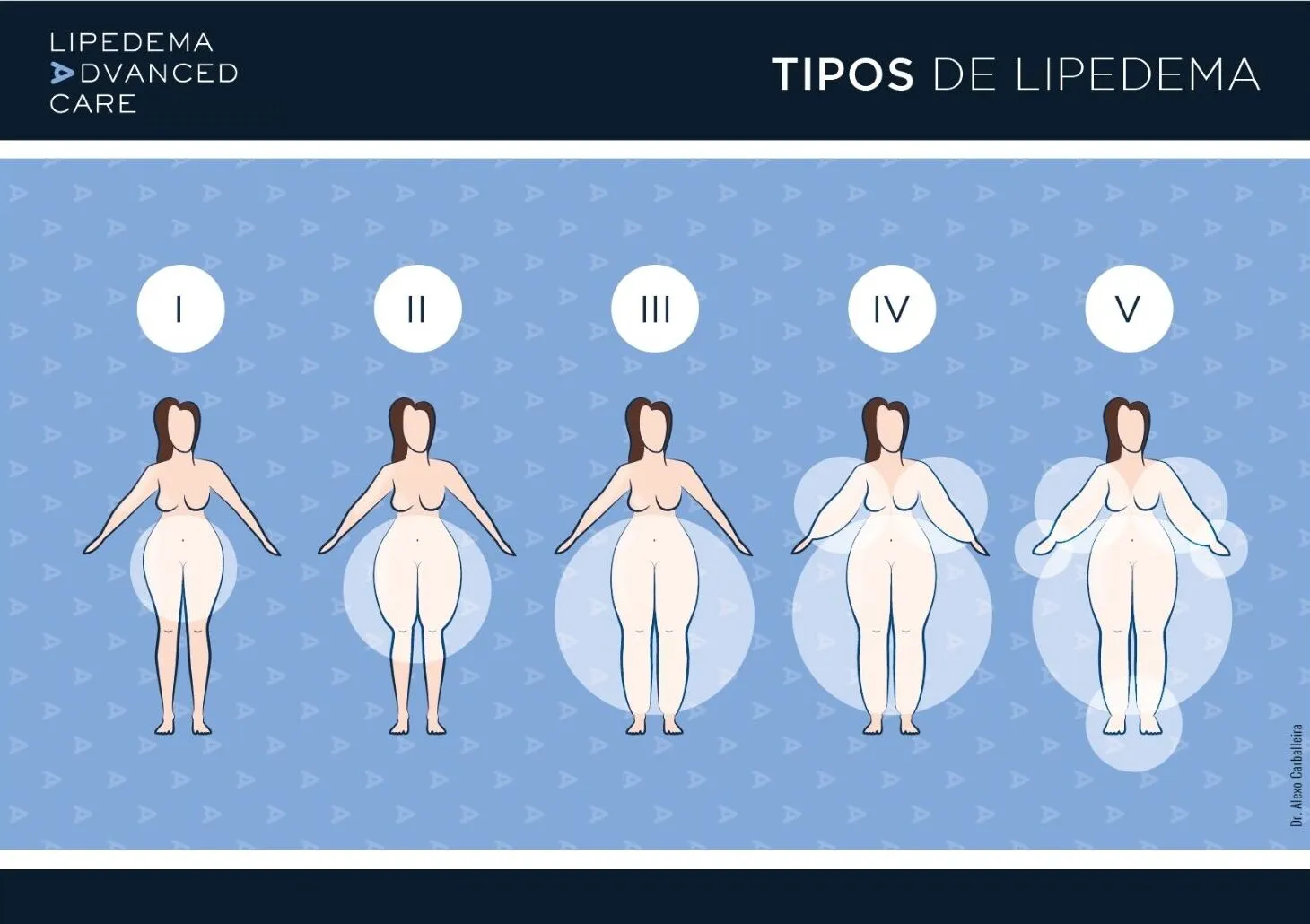 Imagen de los 5 tipos de lipedema: distribución de la grasa por zonas del cuerpo