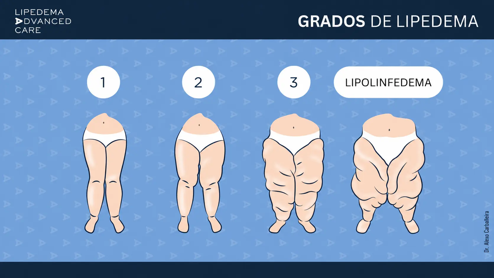 Los tres grados del lipedema (1, 2 y 3) y el lipolinfedema: ilustración comparativa de las piernas