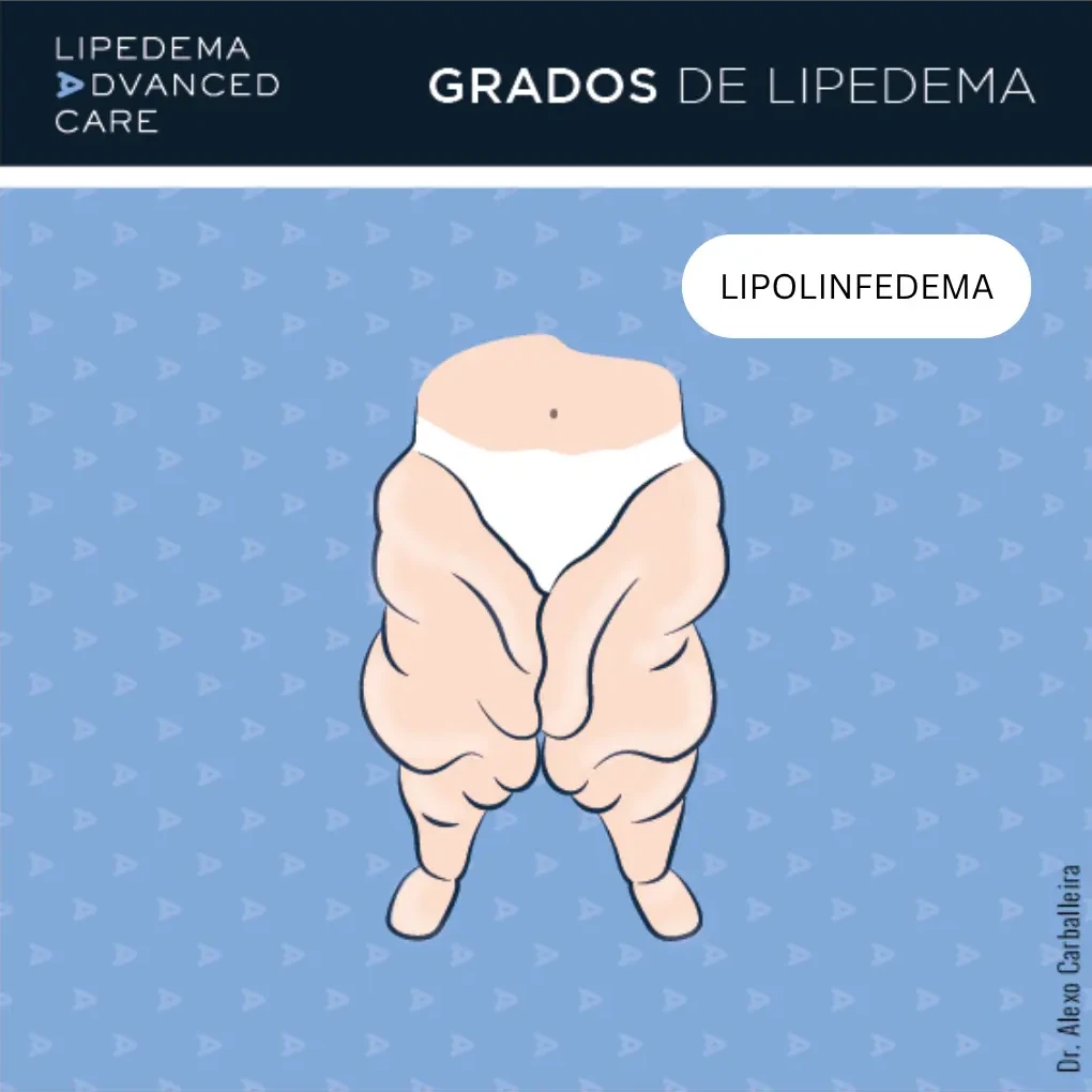 Lipolinfedema: ilustración de piernas con edema y componente linfático asociado al lipedema