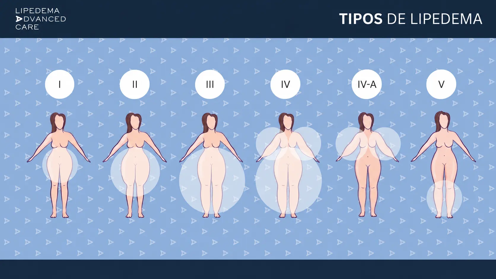 Los tipos de lipedema I, II, III, IV, IV-A y V: distribución de la grasa por zonas del cuerpo
